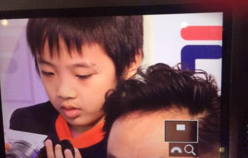 费曼幼年的眼部受伤是否影响了他的健康？|爸爸去哪儿|吴镇宇|视觉功能|新西兰|疤痕